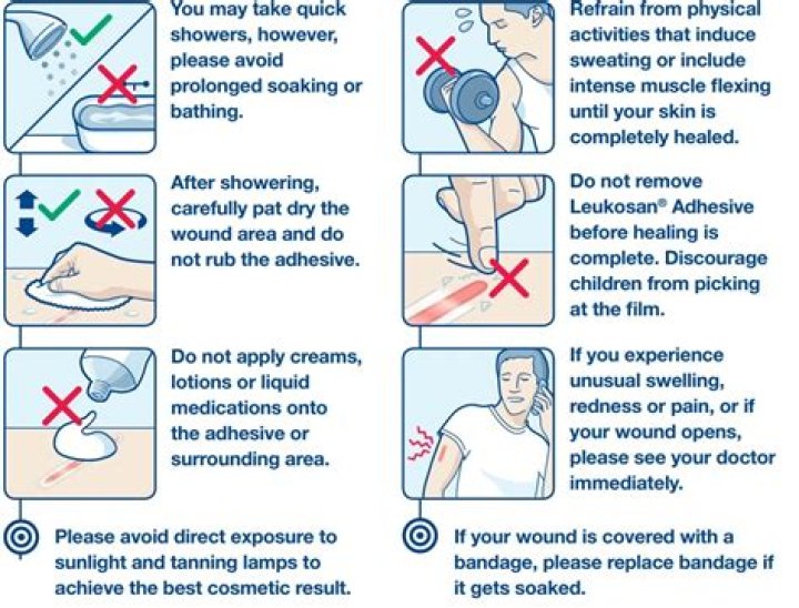 How do you glue a wound shut?