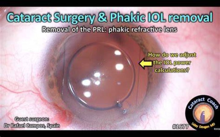 How is IOL power calculated in cataract surgery?